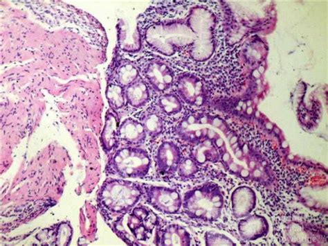 Intestinal Metaplasia (4 of 5) • Picture • MEDtube.net