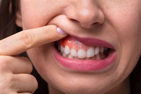 Why are My Gums Sore and What Does it Mean? - Sarasota Dentistry