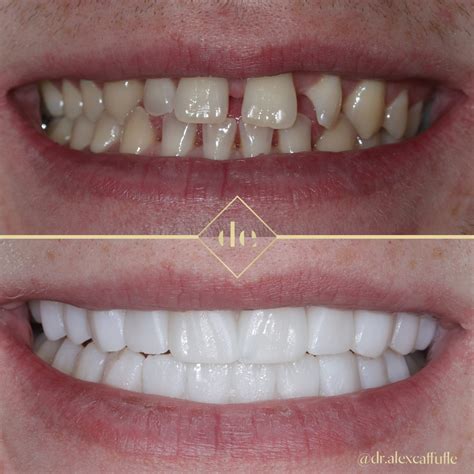 The injection-mould technique for composite veneers – Dentistry