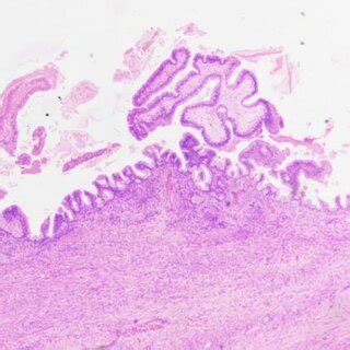 (PDF) Borderline ovarian tumor of mixed sero-mucinous histology and bilateral presentation: a ...