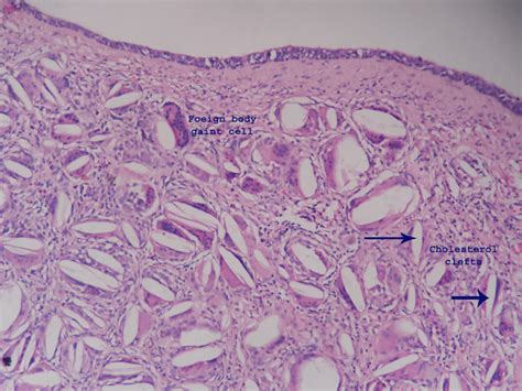 Branchial cleft cyst – Histopathology.guru