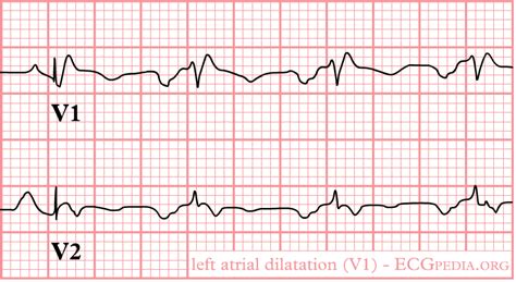 Mitral regurgitation electrocardiogram - wikidoc