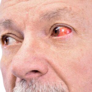 What are the causes of eye bloodshot? - Chadderton Opticians