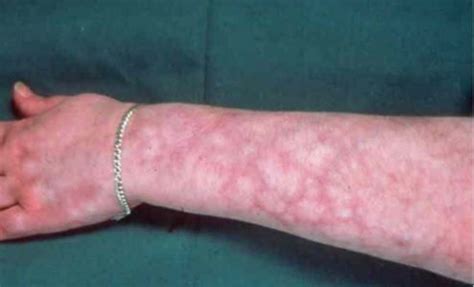 The appearance of Mottled Skin as seen in many patients | Livedo reticularis, Fibromyalgia rash ...