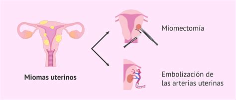 ¿Es mejor hacer embolización de la arteria uterina o miomectomía antes de FIV?