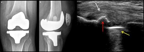 Popliteus Tendinopathy: A Poorly Understood Cause of Knee Pain - Sports Medicine Review