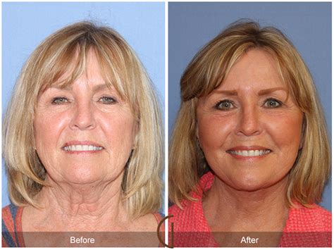 Dr. Kevin Sadati Releases Tip Sheet on Facelift vs. Neck Lift: When A Full Facelift Is Too Much