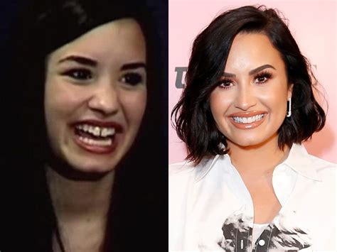 Celebrities With Bad Veneers