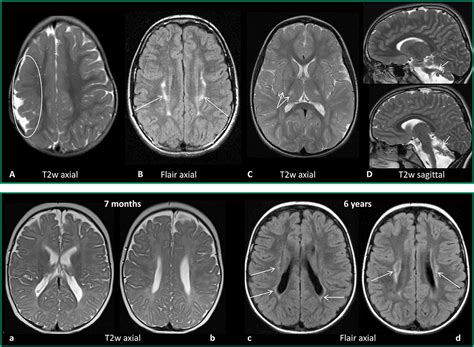 Normal Brain Mri