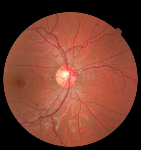 Ophthalmic Image Detailing the Retina and Optic Nerve Inside a Healthy ...