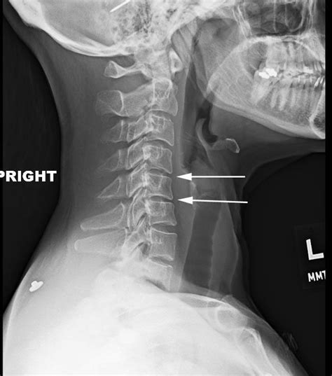 Cervical Degeneratinve Kyphosis | Cervical Spine | Denver Area