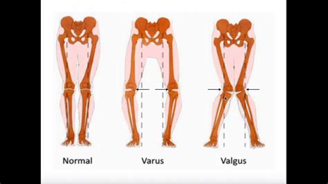 Exercise for Osteoarthritis: Strength Training, Stretching, and two ...