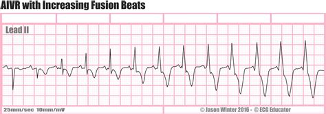 Accelerated Idioventricular Rhythm