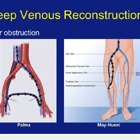 The Palma (femoro-femoral bypass) and May-Husni (saphenopopliteal... | Download Scientific Diagram