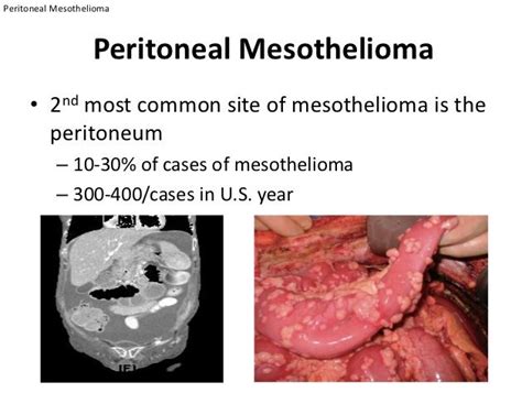 Peritoneal Mesothelioma Symptoms, Life Expectancy | Peritoneal Cancer ...