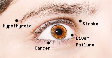 8 Things Your Eyes Are Trying To Tell You About Your Health ...