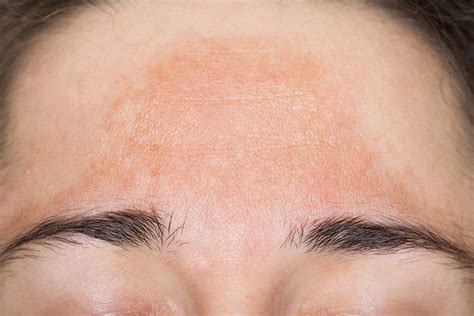 Melasma (Brown Spots or Sun Spots) | Lorna Vanderhaeghe