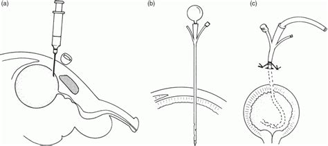 Urinary Diversion | Abdominal Key