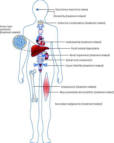 Neuroblastoma | The BMJ