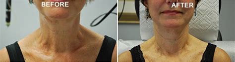 Non-Surgical Neck Lift NY Before & After Pictures