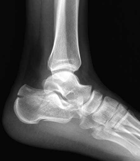 Calcaneal Fractures - Physiopedia