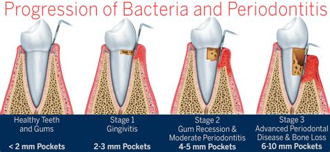 What is periodontal disease? - Pristine Periodontics and Implants