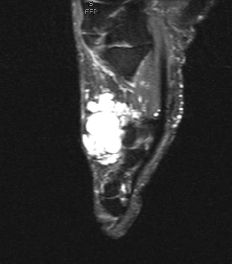 Chondrosarcoma Mri