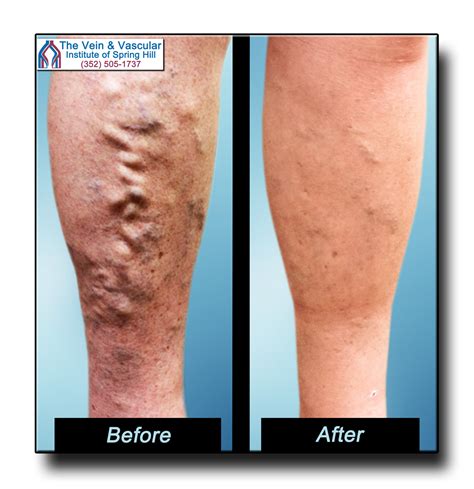 Leg Blood Circulation Metabolism Vein Veins Smooth, 52% OFF