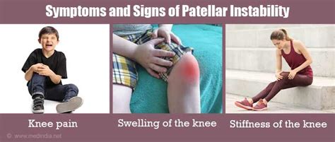 Symptoms and Signs of Patellar Instability