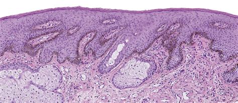 Disorders of Pigmentation | Obgyn Key