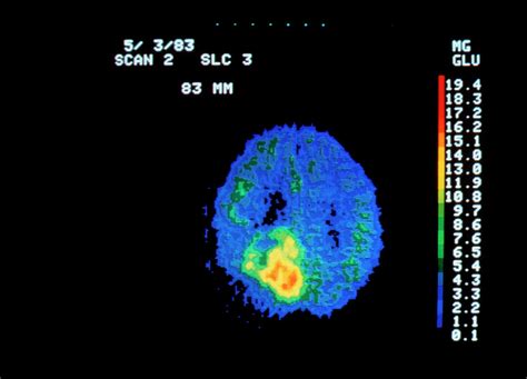 Coloured Pet Scan Of Brain Containing A Tumour Photograph by National Cancer Institute/science ...