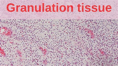 What is Granulation Tissue? - Pathology mini tutorial - YouTube