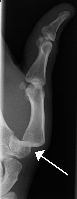 Metacarpophalangeal dislocation (thumb) - WikEM