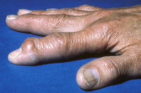 Low-Dose Radiotherapy May Reduce Pain in Finger Osteoarthritis - Rheumatology Advisor