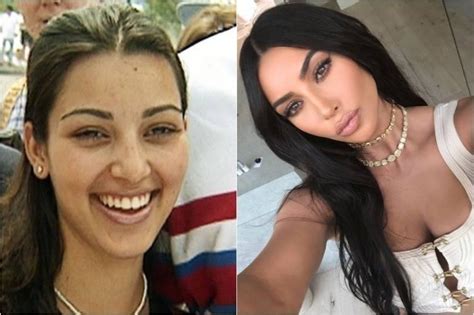 Kim Kardashian Before and After Plastic Surgery