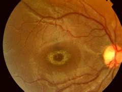 Ophthalmology (retina): Oral Boards Differential diagnosis Flashcards ...