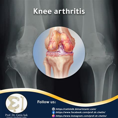 Knee arthritis, the most prominent treatment methods - Dr. What's wrong with you?