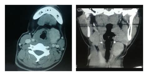 CT scan showing the soft tissue mass in the neck (axial and coronal ...