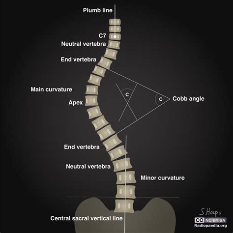 Scoliose idiopathique de l’adolescent | Yotera