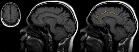 Cingulate Sulcus