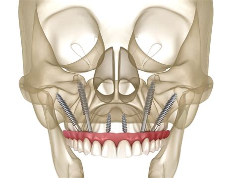 Zygomatic Implants — North Coast Maxillofacial Surgery | Dr Scott Armstrong | Ballina