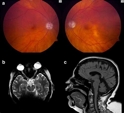 Representative ocular and imaging findings in Patient 1. A—Bilateral... | Download Scientific ...