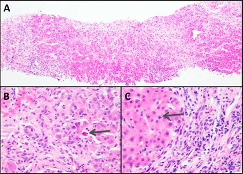 Acute cholestatic hepatitis with exuberant portal and lobular ...