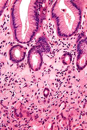 Stomach carcinoma - Libre Pathology