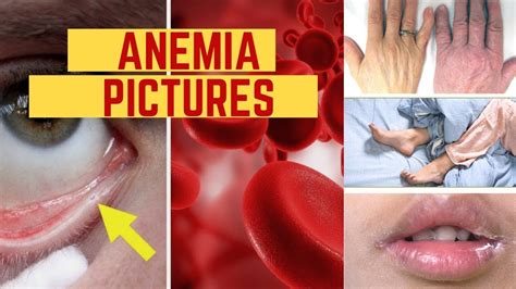 Anemia And Red Spots On Skin