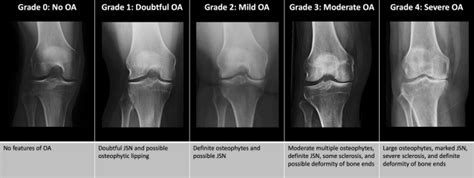 Imaging of Osteoarthritis of the Knee - Radiologic Clinics