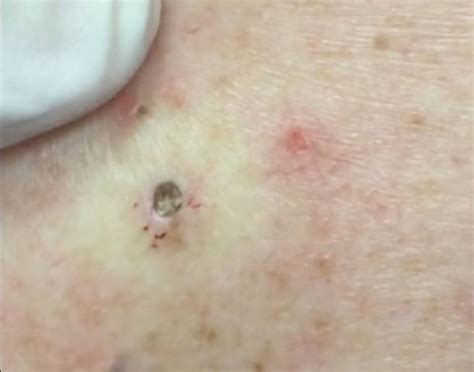 Watch this Dr Pimple Popper huge blackhead unleashed.