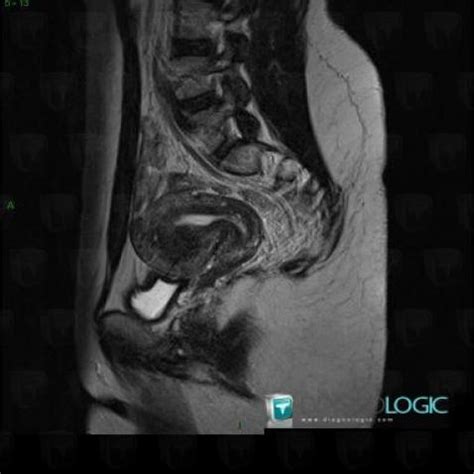 Radiology case : Adenomyosis (US ,MRI) - Diagnologic