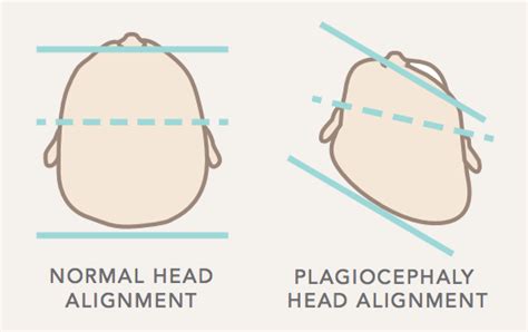 Plagiocephaly | Carolina Kinder Development