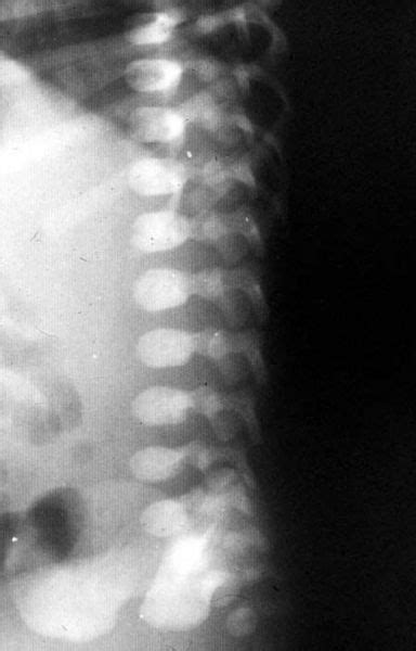 Spondyloepiphyseal dysplasia congenita - wikidoc